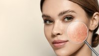 Грижа за кожата при розацея – 6 стъпки за по-спокойно лице
