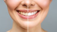 Безупречна усмивка – 4 лесни домашни трика за избелване на зъбите